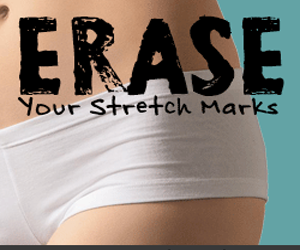 Erase Your Stretch Marks Now