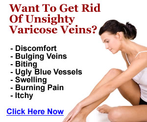 Get Rid Varicose Veins